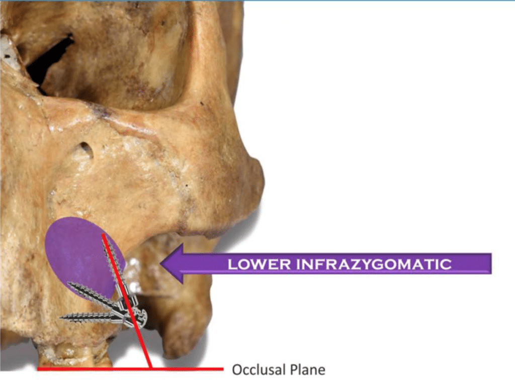 Système universel d'ancrage du squelette | World Orthodontics