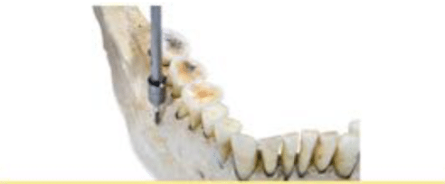 Is a Bone Screw Necessary in Orthodontic Treatment? - London, UK -  Clickalign